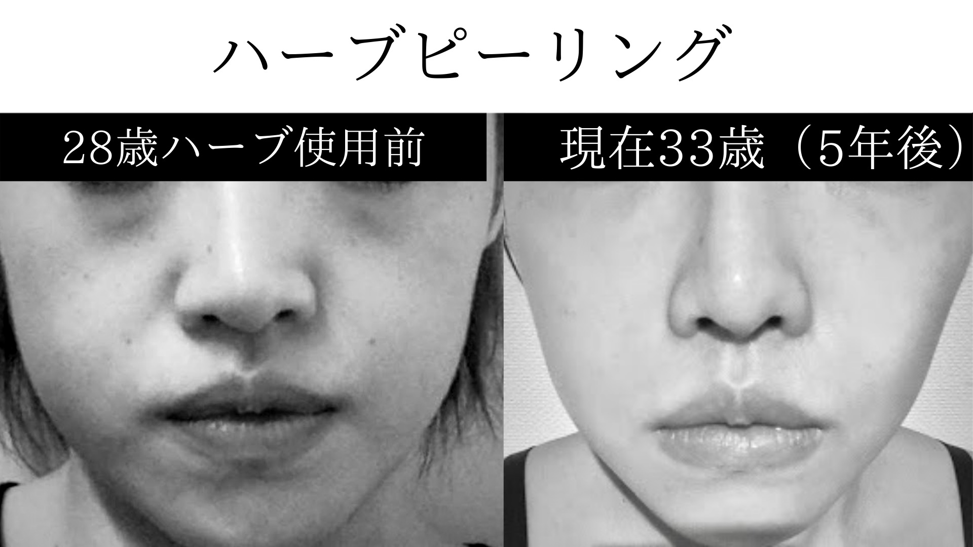 ハーブピーリングシミに使って驚いた ビフォーアフター写 ハーブピーリング福岡エステサロン